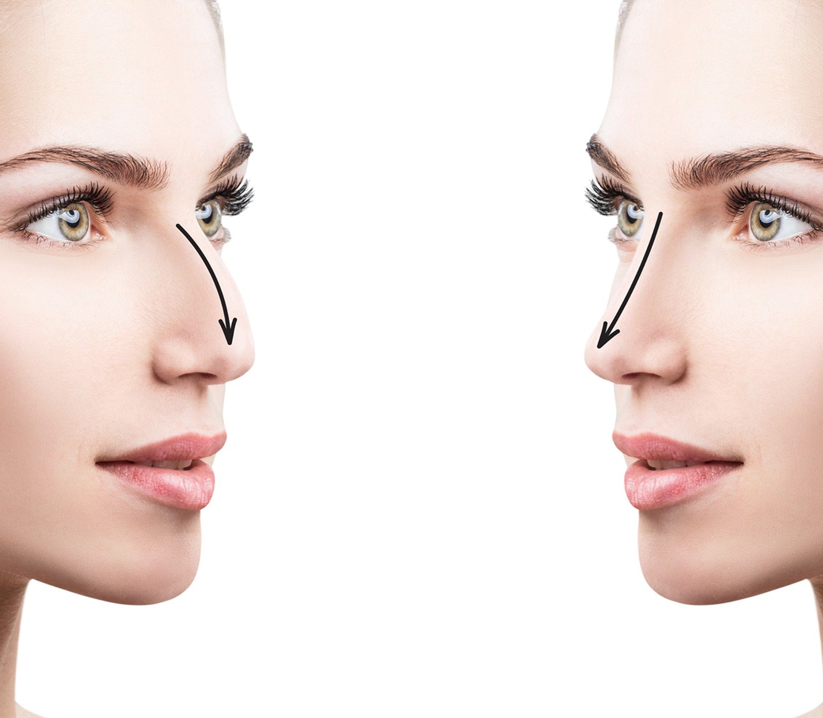 Rhinoplasty | Özel İstanbul Hospital